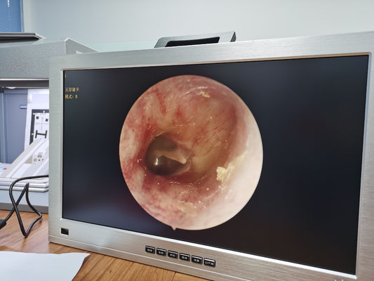 Der 22 Zoll-Monitor integrierte den vollen tragbaren HD-Endoscope-Kamera-System-HNOsatz